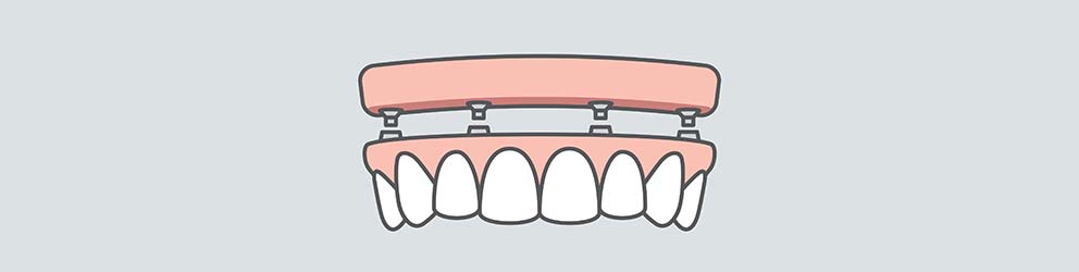 All-on-4 dental implant illustration.