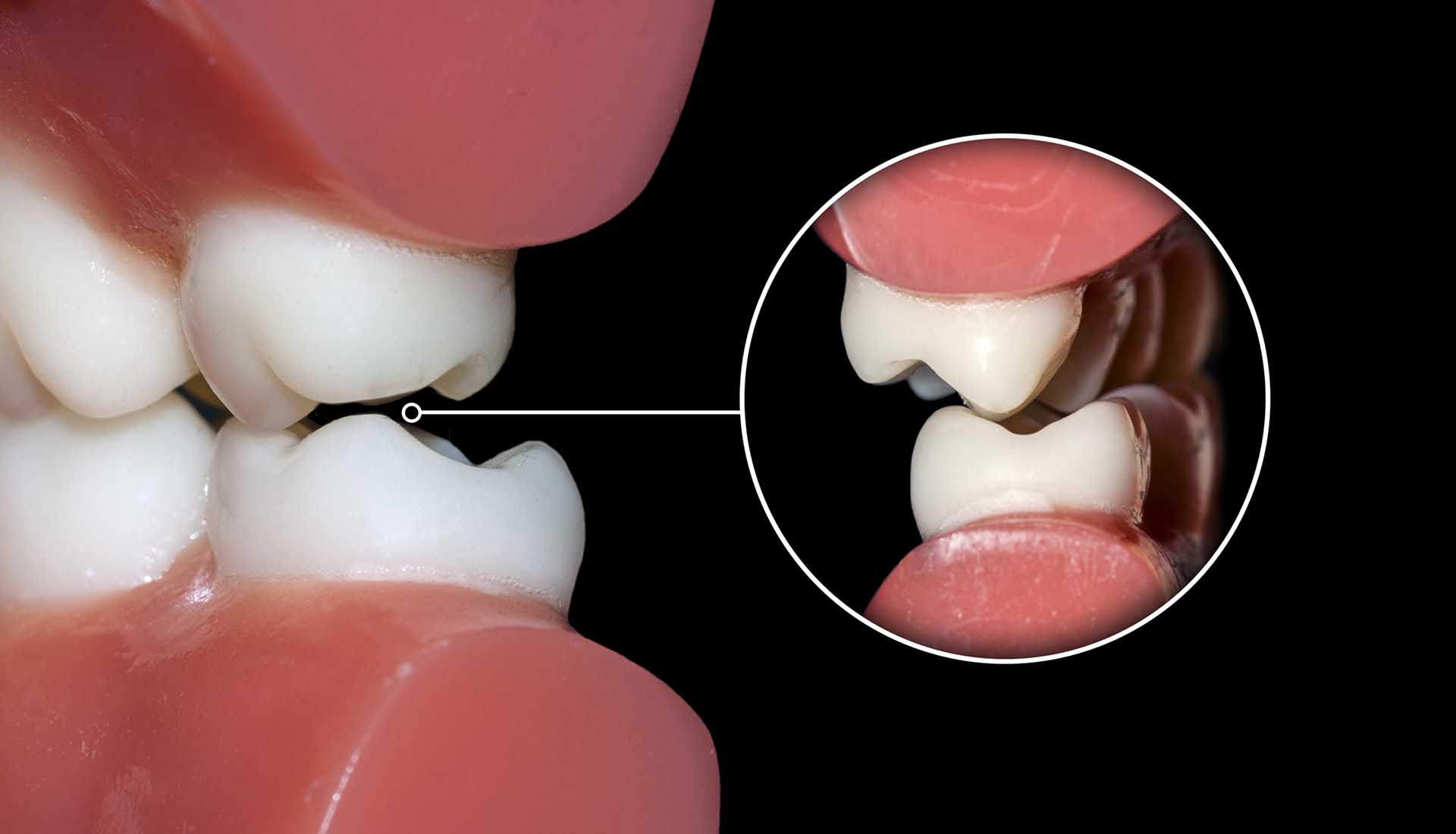 Teeth close up. Teeth grinding treatment Atlanta, GA.