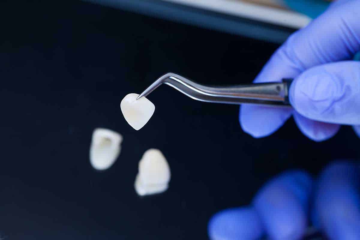 A dentist is holding tweezers for dental ceramic veneers. Closeup hand in blue glove.
