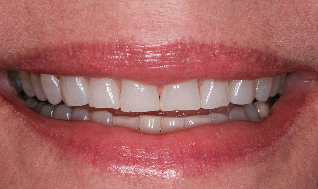 Before dental veneers.