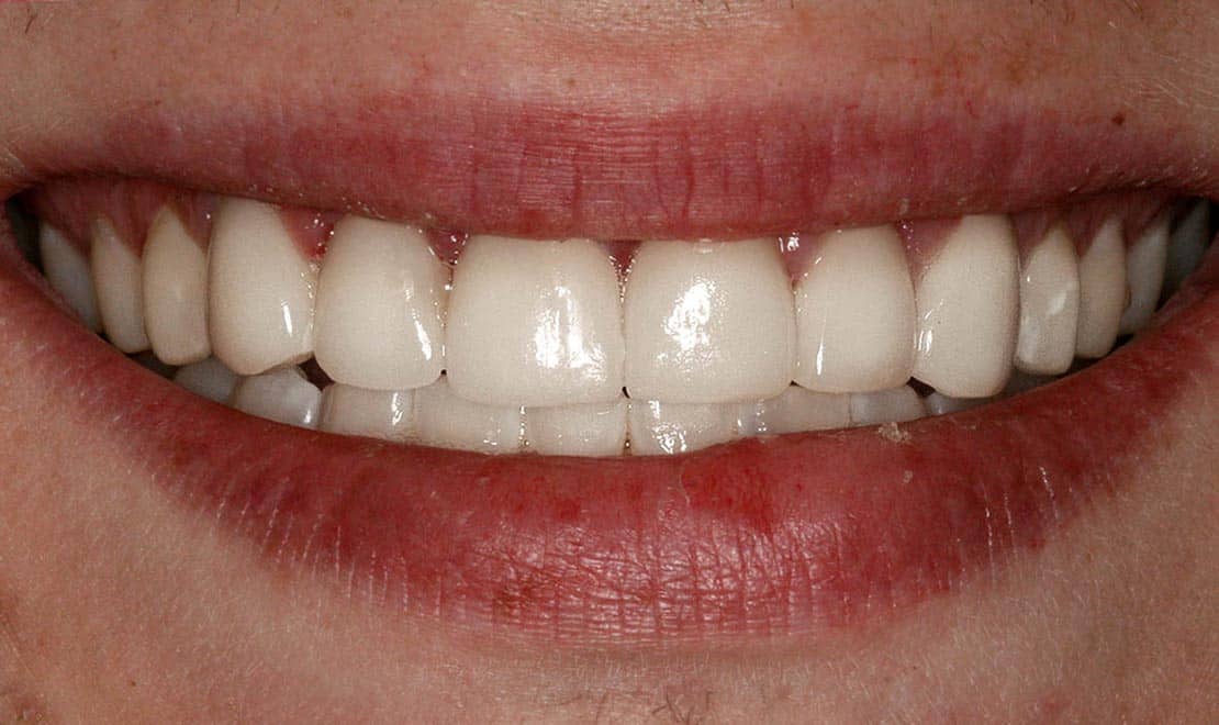 Dental veneers. Atfer photo.