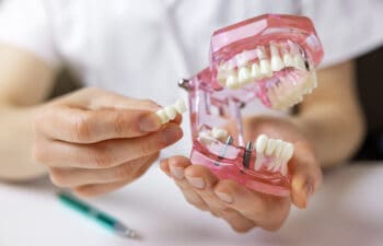 Dental Implant Demonstration Model presented to patient as Dr. David Zelby explains dental implant placement.