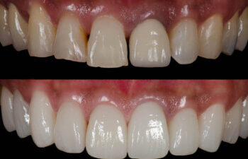 Natural-looking Porcelain Veneers at Aesthetic & Implant Dentistry of Atlanta